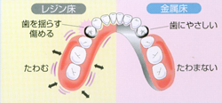 入れ歯：金属床