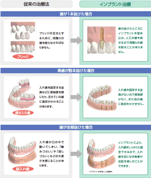 従来の治療法とインプラント治療法との比較