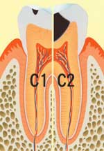 むし歯（C1、C2）