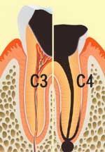 むし歯（C3、C4）