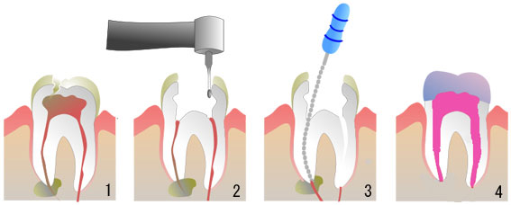 根管治療