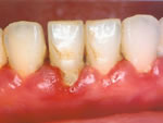 歯周病治療前